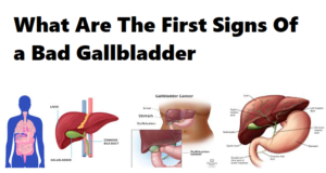 bad gallbladder