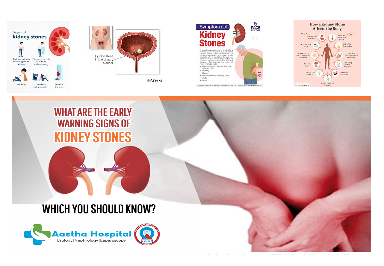 kidney stones